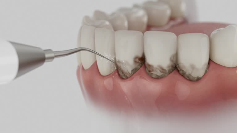 Trusted Wisdom Tooth Removal service in Parkston, SD - Dentist Open Now